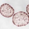 Masern-Viren: Im Kreis Dillingen breiten sich die Masern weiter aus. Vier Fälle sind bestätigt, dazu gibt es einen Verdachtsfall. Das Landratsamt schließt weitere Infektionen nicht aus.