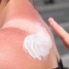 Ein Sonnenbrand kann im schlimmsten Fall Hautkrebs verursachen.