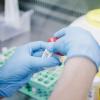Das Affenpockenvirus kann mithilfe von PCR-Tests erkannt werden. Nun wurde im Landkreis Günzburg ein Fall gemeldet.