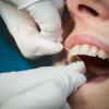 Eine professionelle Zahnreinigung kann helfen, das Gebiss gesund zu halten. Manche Krankenkassen bezuschussen diese Privatleistung.