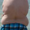 Extremes Übergewicht ruft bis zu 60 Begleiterkrankungen hervor.  