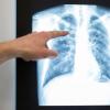 Bei einer ärztlichen Untersuchung kann Tuberkulose auch anhand eines Röntgenbildes festgestellt werden.