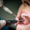 Besser man lässt ihn gar nicht erst entstehen, denn Zahnstein lässt sich nur mit einer professionellen Zahnreinigung entfernen.