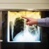 Ein Arzt zeigt einen Tuberkulose-Fall anhand eines Röntgenbildes.
