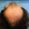 Laut der Studie sollte es möglich sein, bereits abgestorbene Haarfollikel zu reaktivieren.