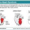 Das Broken-Heart-Syndrom erinnert an einen Herzinfarkt. Tatsächlich verändert sich dabei aber vor allem die linke Herzkammer.