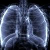Bei Mukoviszidose verstopft zäher Schleim die Lunge – hier ein Röntgenbild. 