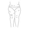 Stadium 3 zeigt eine ausgeprägte Umfangsvermehrung mit überhängenden Gewebeanteilen (Wammenbildung) an Armen und Beinen.