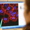 Monitorbild von Melanom-Zellen (schwarzer Hautkrebs) im Labor des Instituts für Experimentelle Gentherapie und Tumorforschung (IEGT) der Universitätsmedizin Rostock.