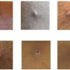 Das von der UK Health Security Agency zur Verfügung gestellte Bild zeigt Hautläsionen von Affenpocken.