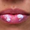 Lippenherpes ist weit verbreitet. Was können Betroffene tun, damit die Bläschen gar nicht erst entstehen?