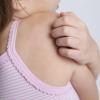 Mehr als nur ein Hautproblem: Bei Kindern steigt mit einer Psoriasis auch das Risiko von Folgeerkrankungen.