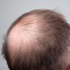 Besonders Männer leiden unter Haarausfall. Vielen könnte die neue Studie Hoffnung machen.
