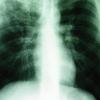 Tuberkulose zählt mit jährlich fast neun Millionen Neuerkrankungen zu den schlimmsten Infektionskrankheiten weltweit.