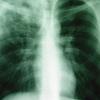 Tuberkulose ist eine Lungenkrankheit, die durch Bakterien verursacht wird. Das Röntgenbild zeigt eine offene Tuberkulose. 