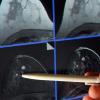 Eine Magnetresonanz-Mammographie macht einen winzigen Tumor in der Brust einer Patientin sichtbar. 