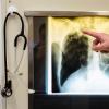 Knapp 6000 Deutsche erkrankten 2016 an Tuberkulose.
