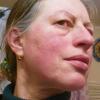Eine schmerzhafte Hautreaktion machte der Meringerin Margit Hummel nach dem Tragen einer Maske gemäß FFP2-Standard zu schaffen. Noch etliche Tage später ist die Rötung zu sehen.