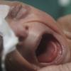 Ein Neugeborenes, das an der Erbkrankheit Progerie leidet.