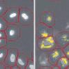 Das Mikroskop macht menschliche Neuroblastomzellen sichtbar. Links: Zellkerne und Zellmembran (rote Konturlinien). Rechts: fluoreszenzmarkierte Ablagerungen (gelb). Ein Neuroblastom ist ein Tumor im Nervensystem.  