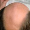 Viele Männer fürchten sich davor, eine Glatze zu bekommen. Einige Körpermerkmale geben Hinweise, wie wahrscheinlich frühzeitiger Haarausfall ist.