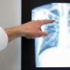 Röntgenbild einer Lunge. Im vergangenem Jahr würden rund 4480 neue Tuberkulose-Fälle in Deutschland registriert.