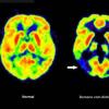 Haben die Amyloid-Plaques schon irreversible Schäden im Gehirn angerichtet, nützt ihre Entfernung nichts mehr. (Archivbild)