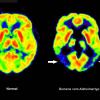 Die Abbildung zeigt zwei Gehirne, eines im gesunden Zustand (links) und eines mit Alzheimer-Krankheit (rechts).  