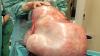 Der 32 Kilogramm schwere Tumor, der der jungen Frau entfernt wurde, liegt in einem Raum der Universitätsklinik.