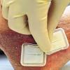Eine Krankenschwester behandelt im Bietigheimer Krankenhaus eine Patientin, die mit einem Ulkus am Fuß erkrankt ist, mit einem mit Maden gefülltem kleinen “Kissen“. DPA