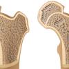 Ein normaler Knochen (links) und ein Knochen mit Osteoporose. Ein normaler Knochen (links) und ein Knochen mit Osteoporose.
