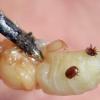 (geha)   Forscher der baden-württembergischen Universität Hohenheim und Bienenkundler der Bayerischen Landesanstalt für Weinbau und Gartenbau (LWG) in Veitshöchheim haben offenbar durch Zufall ein Mittel gefunden, das gegen einen gefürchteten Bienenschädling, die Varroa-Milbe, wirkt. Lithiumchlorid könne das lang gesuchte Heilmittel gegen die Milbe sein, heißt es in einer Pressemitteilung der LWG. Forschungsansatz im Projekt „BeePax“ sei gewesen, mittels des RNA-Interferenz-Verfahrens lebenswichtige Gene in der Varroa Milbe auszuschalten. Dabei stellte sich heraus, dass die Chemikalie Lithiumchlorid, die bei der Isolierung der RNA-Bruchstücke eingesetzt wurde, die auf den Bienen und ihrer Brut (im Bild eine von Milben befallene Drohne) sitzenden Milben abtötet. Bislang mussten Imker befallene Bienenstöcke mit aggressiven organischen Säuren oder chemischen Milbenbekämpfungsmitteln behandeln, die allerdings Resistenzprobleme und Rückstände verursachen. Lithiumchlorid sei hingegen einfach herzustellen und relativ preiswert, erklärten die Forscher.