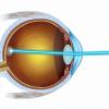 Neue Behandlungsmethode: Mit dem Nanosekunden-Laser kann man jetzt auch das Frühstadium der altersbezogenen Makular-Degeneration therapieren. Der Laser dringt durch die Hornhaut, die Linse und den Glaskörper bis zur Netzhaut. Eine schonende Methode, sagen Experten.