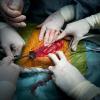 Ärzte verschließen nach einer Nierentransplantation die Wunde.