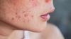 Hautprobleme wie Akne können ein typisches Symptom für einen Vitamin-D-Mangel sein.